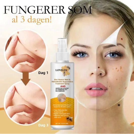 A collage of images showing a bottle of Bee Venom Wart Remover Spray with a graphic depicting the product's use on skin, indicating wart removal.