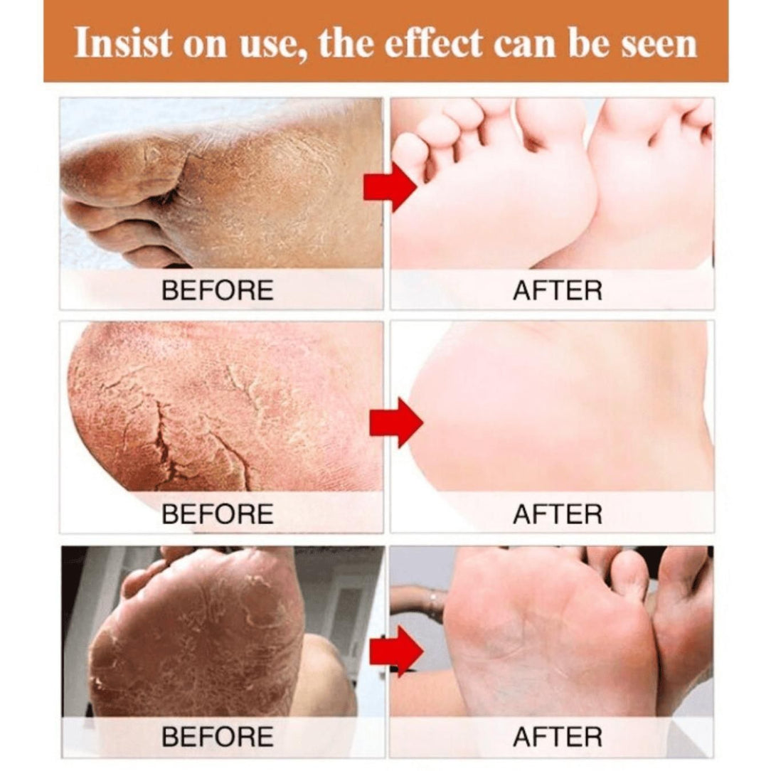 Before and after comparison of foot skin treatment showing improved skin condition.