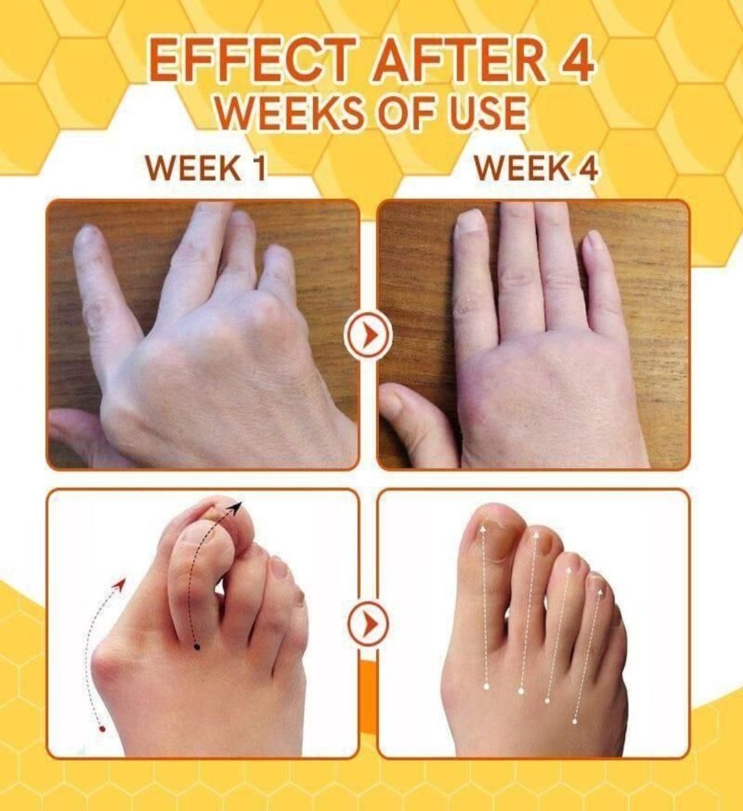 Bee Venom Spider Veins Spray  BUY ONE GET ONE FREE .