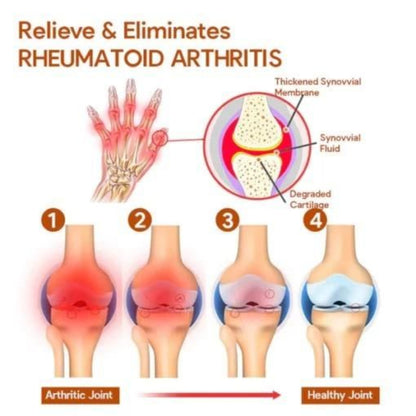 Meniscus Pain Relief Cream Buy One Get One Free)- 50g