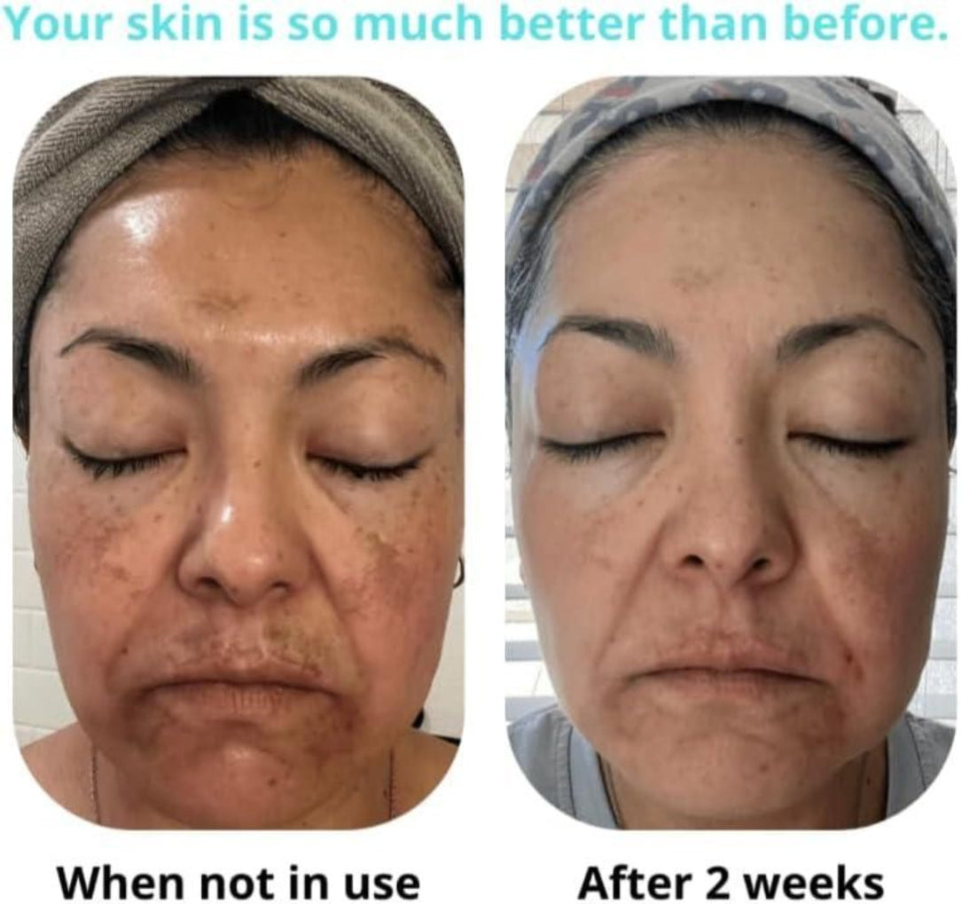 Before and after comparison of a woman's face with text indicating improvement over two weeks.