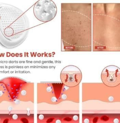Illustration of a skin treatment process with before and after effects, showing micro darts and skin texture changes.