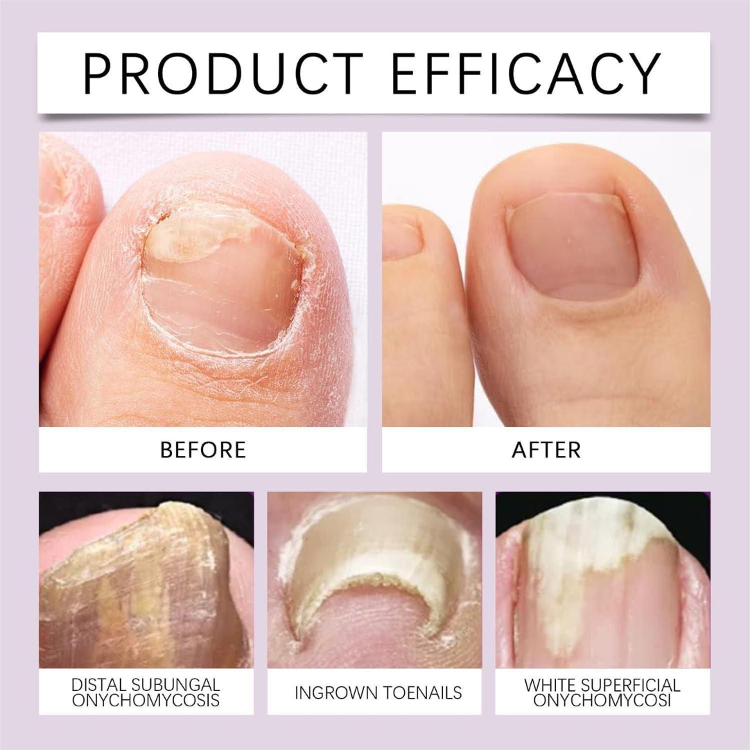 Before and after comparison of nail conditions with product efficacy text.